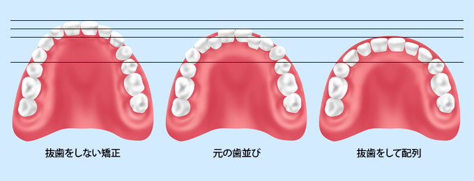 矯正治療における抜歯の必要性について